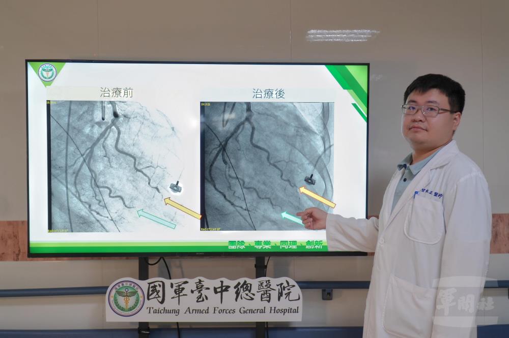 心臟內科甘承正醫師為患者進行心導管檢查發現血栓阻塞，立即進行血栓抽吸並注射抗血栓藥物，成功恢復動脈血流。（國軍臺中總醫院提供）